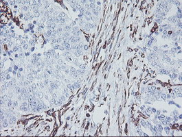 KIF2C / MCAK Antibody - IHC of paraffin-embedded Adenocarcinoma of Human ovary tissue using anti-KIF2C mouse monoclonal antibody. (Heat-induced epitope retrieval by 10mM citric buffer, pH6.0, 100C for 10min).