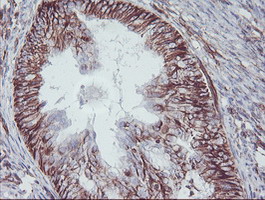 KIF2C / MCAK Antibody - IHC of paraffin-embedded Adenocarcinoma of Human endometrium tissue using anti-KIF2C mouse monoclonal antibody. (Heat-induced epitope retrieval by 10mM citric buffer, pH6.0, 100C for 10min).