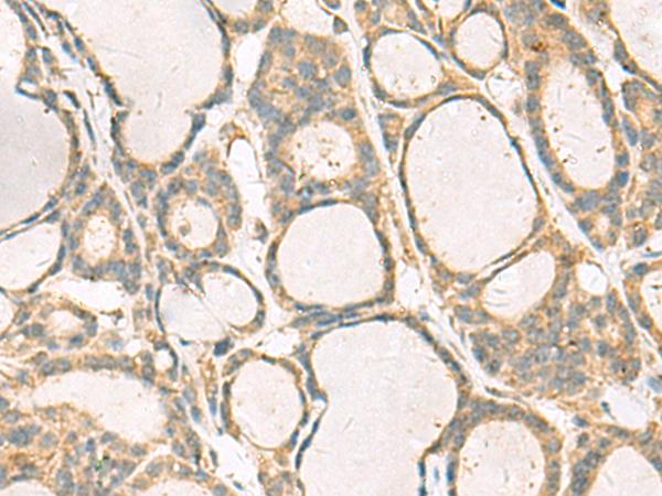 KIF2C / MCAK Antibody - Immunohistochemistry of paraffin-embedded Human thyroid cancer tissue  using KIF2C Polyclonal Antibody at dilution of 1:70(×200)