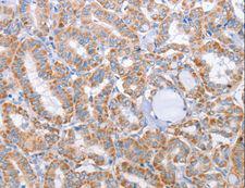 KIF3A Antibody - Immunohistochemistry of paraffin-embedded Human thyroid cancer using KIF3A Polyclonal Antibody at dilution of 1:25.