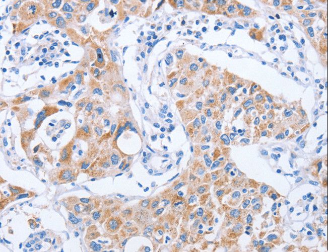 KIF3A Antibody - Immunohistochemistry of paraffin-embedded Human lung cancer using KIF3A Polyclonal Antibody at dilution of 1:25.