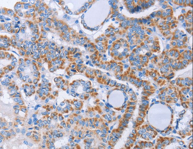 KIF3A Antibody - Immunohistochemistry of paraffin-embedded Human thyroid cancer using KIF3A Polyclonal Antibody at dilution of 1:40.