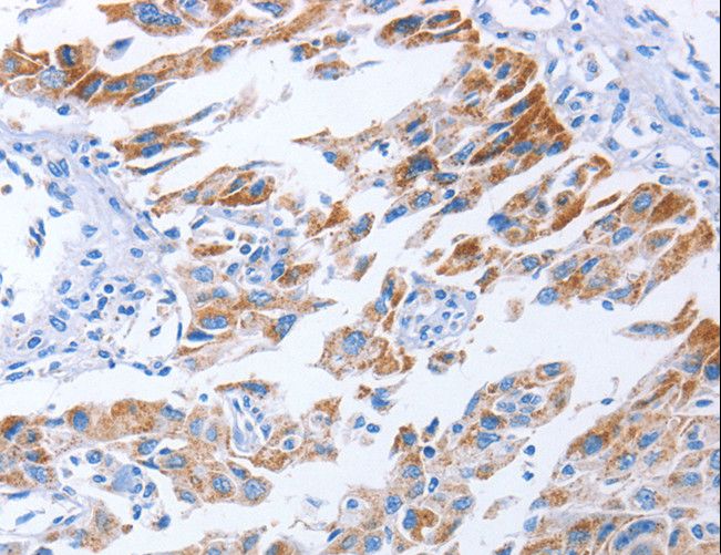 KIF3A Antibody - Immunohistochemistry of paraffin-embedded Human lung cancer using KIF3A Polyclonal Antibody at dilution of 1:40.
