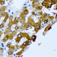 KIF3A Antibody - Immunohistochemical analysis of KIF3A staining in human liver cancer formalin fixed paraffin embedded tissue section. The section was pre-treated using heat mediated antigen retrieval with sodium citrate buffer (pH 6.0). The section was then incubated with the antibody at room temperature and detected using an HRP conjugated compact polymer system. DAB was used as the chromogen. The section was then counterstained with hematoxylin and mounted with DPX.