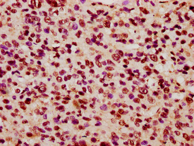 KIF3C Antibody - Immunohistochemistry Dilution at 1:600 and staining in paraffin-embedded human glioma cancer performed on a Leica BondTM system. After dewaxing and hydration, antigen retrieval was mediated by high pressure in a citrate buffer (pH 6.0). Section was blocked with 10% normal Goat serum 30min at RT. Then primary antibody (1% BSA) was incubated at 4°C overnight. The primary is detected by a biotinylated Secondary antibody and visualized using an HRP conjugated SP system.