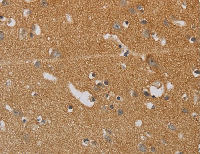 KIF4A Antibody - Immunohistochemistry of paraffin-embedded Human liver cancer using KIF4A Polyclonal Antibody at dilution of 1:40.