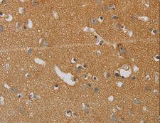KIF4A Antibody - Immunohistochemistry of paraffin-embedded Human liver cancer using KIF4A Polyclonal Antibody at dilution of 1:40.