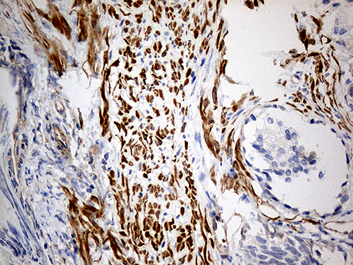 KIF6 Antibody - Immunohistochemical staining of paraffin-embedded Human prostate tissue within the normal limits using anti-KIF6 mouse monoclonal antibody. (Heat-induced epitope retrieval by 1mM EDTA in 10mM Tris buffer. (pH8.5) at 120°C for 3 min. (1:500)