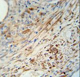 KIF9 Antibody - KIF9 antibody immunohistochemistry of formalin-fixed and paraffin-embedded human prostate carcinoma followed by peroxidase-conjugated secondary antibody and DAB staining.