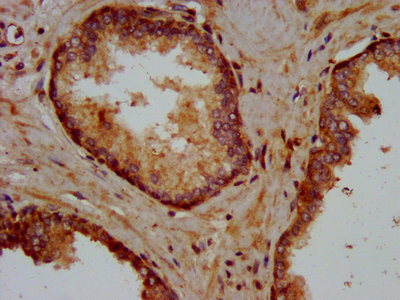 KIFAP3 / KAP3 Antibody - IHC image of KIFAP3 Antibody diluted at 1:400 and staining in paraffin-embedded human prostate cancer performed on a Leica BondTM system. After dewaxing and hydration, antigen retrieval was mediated by high pressure in a citrate buffer (pH 6.0). Section was blocked with 10% normal goat serum 30min at RT. Then primary antibody (1% BSA) was incubated at 4°C overnight. The primary is detected by a biotinylated secondary antibody and visualized using an HRP conjugated SP system.