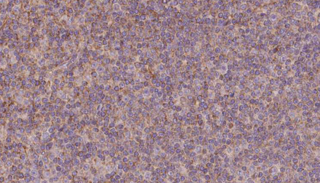 KIFC3 Antibody - 1:100 staining human lymph carcinoma tissue by IHC-P. The sample was formaldehyde fixed and a heat mediated antigen retrieval step in citrate buffer was performed. The sample was then blocked and incubated with the antibody for 1.5 hours at 22°C. An HRP conjugated goat anti-rabbit antibody was used as the secondary.