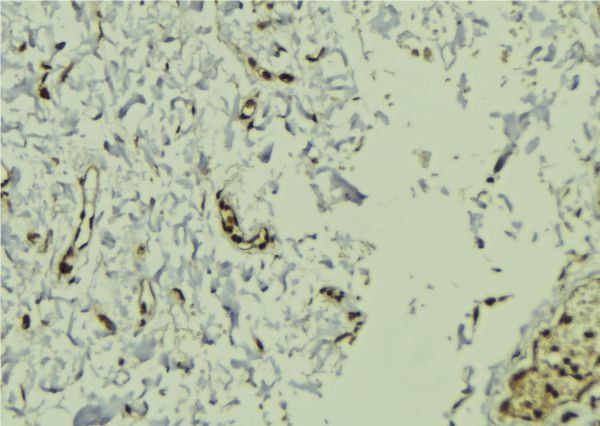 KIND2 / FERMT2 Antibody - 1:100 staining human breast carcinoma tissue by IHC-P. The sample was formaldehyde fixed and a heat mediated antigen retrieval step in citrate buffer was performed. The sample was then blocked and incubated with the antibody for 1.5 hours at 22°C. An HRP conjugated goat anti-rabbit antibody was used as the secondary.