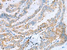 Kinesin 5A / KIF5A Antibody - Immunohistochemistry of paraffin-embedded Human thyroid cancer tissue  using KIF5A Polyclonal Antibody at dilution of 1:30(×200)