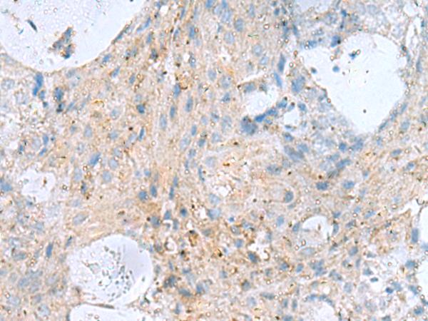 Kinesin 5A / KIF5A Antibody - Immunohistochemistry of paraffin-embedded Human ovarian cancer tissue  using KIF5A Polyclonal Antibody at dilution of 1:30(×200)