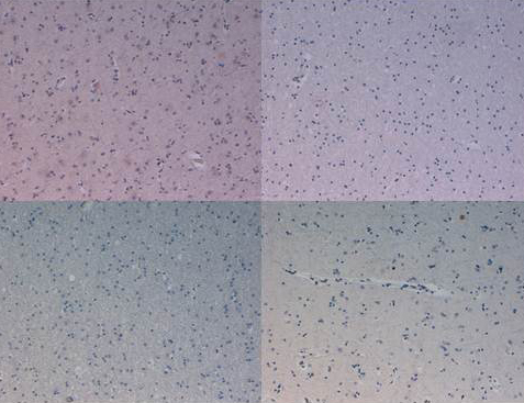 Kinesin Heavy Chain / KIF5B Antibody - Immunohistochemistry of Mouse Anti-AKT3 antibody. Tissue: human prostate carcinoma. A) AKT-3 antibody produced using CELLine, B) AKT-3 antibody produced using roller bottle. Fixation: formalin fixed paraffin embedded. Antigen retrieval: not required. Primary antibody: AKT-3 antibody at 10 µg/mL for 1 h at RT. Secondary antibody: Peroxidase mouse secondary antibody at 1:10,000 for 1 h at RT. Localization: AKT3 is nuclear and occasionally cytoplasmic. Staining: AKT3 as precipitated brown signal with hematoxylin purple nuclear counterstain.
