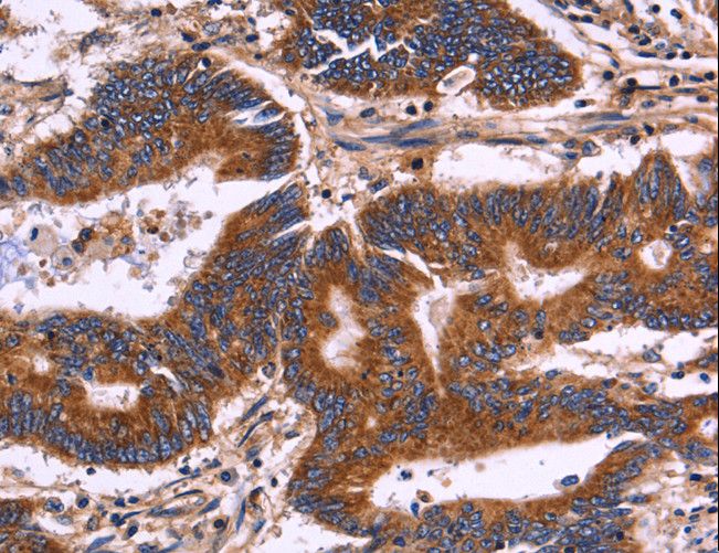 KIR2DL1+3+4 + KIR2DS4 Antibody - Immunohistochemistry of paraffin-embedded Human thyroid cancer using KIR2DL3/1/4/S4 Polyclonal Antibody at dilution of 1:30.