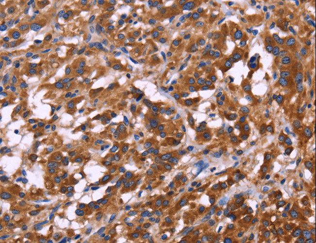 KIR2DL1+3+4 + KIR2DS4 Antibody - Immunohistochemistry of paraffin-embedded Human thyroid cancer using KIR2DL3/1/4/S4 Polyclonal Antibody at dilution of 1:30.