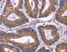 KIR2DL1+3+4 + KIR2DS4 Antibody - Immunohistochemistry of paraffin-embedded Human liver cancer using KIR2DL3/1/4/S4 Polyclonal Antibody at dilution of 1:40.