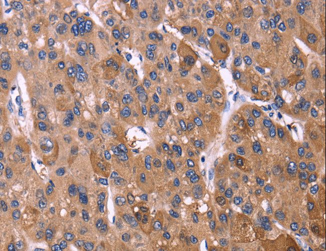 KIR2DL1+3+4 + KIR2DS4 Antibody - Immunohistochemistry of paraffin-embedded Human liver cancer using KIR2DL3/1/4/S4 Polyclonal Antibody at dilution of 1:40.