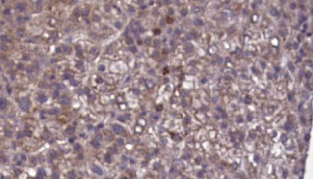 KIR2DL1 / CD158a Antibody - 1:100 staining human liver carcinoma tissues by IHC-P. The sample was formaldehyde fixed and a heat mediated antigen retrieval step in citrate buffer was performed. The sample was then blocked and incubated with the antibody for 1.5 hours at 22°C. An HRP conjugated goat anti-rabbit antibody was used as the secondary.