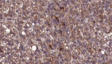 KIR2DL3 / CD152B2 Antibody - 1:100 staining human liver carcinoma tissues by IHC-P. The sample was formaldehyde fixed and a heat mediated antigen retrieval step in citrate buffer was performed. The sample was then blocked and incubated with the antibody for 1.5 hours at 22°C. An HRP conjugated goat anti-rabbit antibody was used as the secondary.