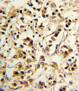 KIR2DL4 Antibody - Formalin-fixed and paraffin-embedded human breast carcinoma reacted with KIR2DL4 Antibody , which was peroxidase-conjugated to the secondary antibody, followed by DAB staining. This data demonstrates the use of this antibody for immunohistochemistry; clinical relevance has not been evaluated.