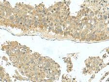 KIR2DL5A / KIR2DL5 Antibody - Immunohistochemistry of paraffin-embedded Human liver cancer tissue  using KIR2DL5A Polyclonal Antibody at dilution of 1:40(×200)