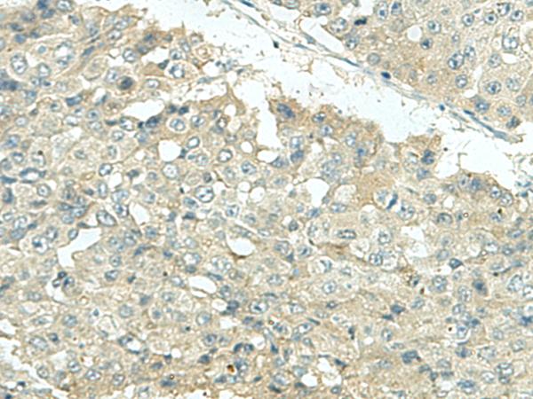 KIR2DL5A / KIR2DL5 Antibody - Immunohistochemistry of paraffin-embedded Human liver cancer tissue  using KIR2DL5A Polyclonal Antibody at dilution of 1:35(×200)