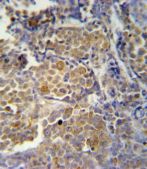 KIR2DS2 / CD158j Antibody - KIR2DS2 Antibody immunohistochemistry of formalin-fixed and paraffin-embedded human skin carcinoma followed by peroxidase-conjugated secondary antibody and DAB staining.