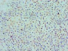 KIR2DS4 Antibody - Immunohistochemistry of paraffin-embedded human breast cancer using antibody at 1:100 dilution.