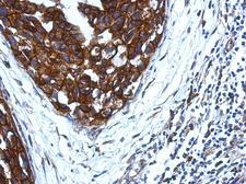 KIR2DS4 Antibody - IHC of paraffin-embedded Breast ca, using KIR2DS4 antibody at 1:500 dilution.