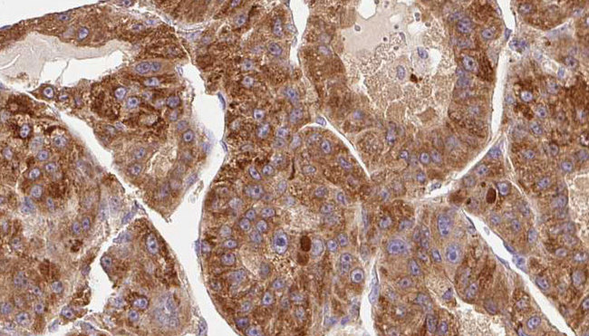 KIR3DL1 Antibody - 1:100 staining human liver carcinoma tissues by IHC-P. The sample was formaldehyde fixed and a heat mediated antigen retrieval step in citrate buffer was performed. The sample was then blocked and incubated with the antibody for 1.5 hours at 22°C. An HRP conjugated goat anti-rabbit antibody was used as the secondary.