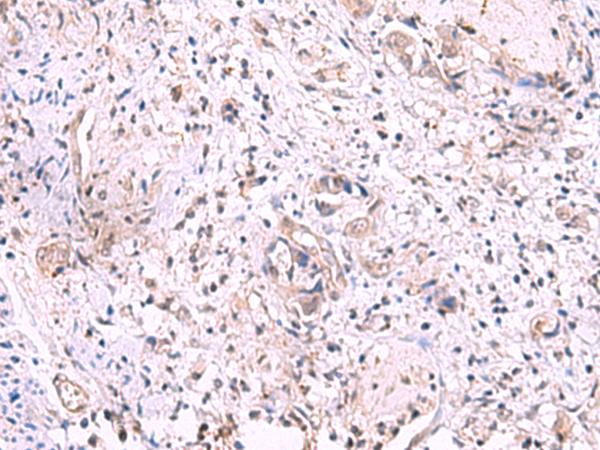 KIR3DL1 Antibody - Immunohistochemistry of paraffin-embedded Human cervical cancer tissue  using KIR3DL1 Polyclonal Antibody at dilution of 1:95(×200)