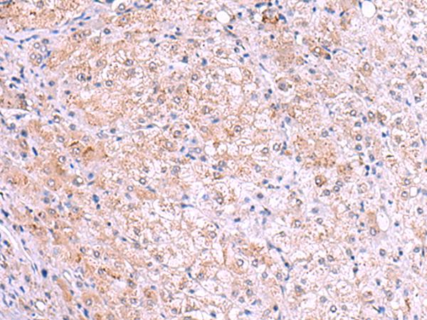 KIR3DL1 Antibody - Immunohistochemistry of paraffin-embedded Human liver cancer tissue  using KIR3DL1 Polyclonal Antibody at dilution of 1:105(×200)