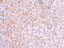 KIR3DL1 Antibody - Immunohistochemistry of paraffin-embedded Human liver cancer tissue  using KIR3DL1 Polyclonal Antibody at dilution of 1:105(×200)