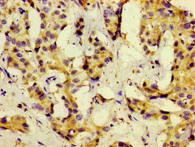 KISS1 / Kisspeptin / Metastin Antibody - Immunohistochemistry image of paraffin-embedded human liver cancer at a dilution of 1:100