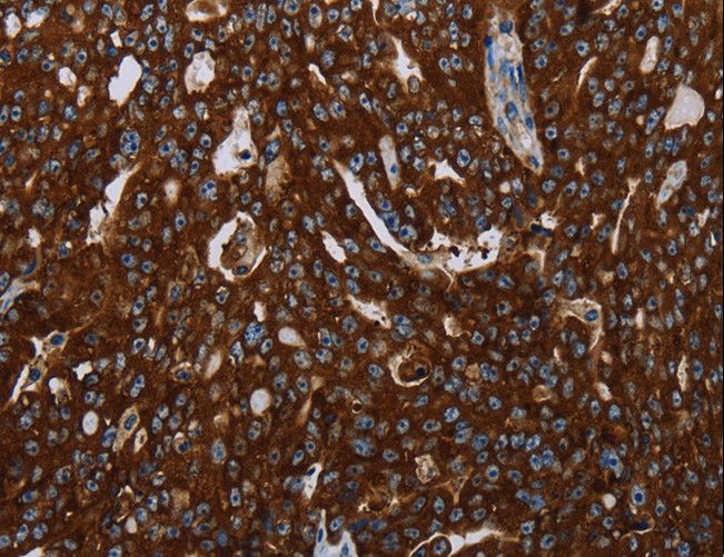 KISS1R / GPR54 Antibody - Immunohistochemistry of paraffin-embedded Human esophagus cancer using KISS1R Polyclonal Antibody at dilution of 1:30.
