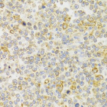 KISS1R / GPR54 Antibody - Immunohistochemistry of paraffin-embedded Human B cell lymphoma using KISS1R Polyclonal Antibody at dilution of 1:100 (40x lens).