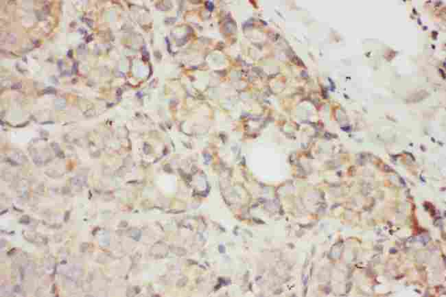 KITLG / SCF Antibody - Anti-SCF antibody, IHC(P): Human Mammary Cancer Tissue