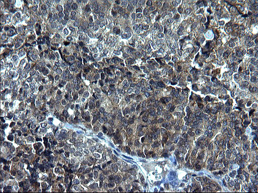 KITLG / SCF Antibody - IHC of paraffin-embedded Adenocarcinoma of Human endometrium tissue using anti-KITLG mouse monoclonal antibody. (Heat-induced epitope retrieval by 1 mM EDTA in 10mM Tris, pH8.5, 120°C for 3min).