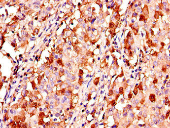 KL / Klotho Antibody - Immunohistochemistry of paraffin-embedded human lung cancer using KL Antibody at dilution of 1:100