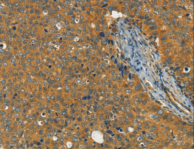 KLC1 / Kinesin Light Chain 1 Antibody - Immunohistochemistry of paraffin-embedded Human cervical cancer using KLC1 Polyclonal Antibody at dilution of 1:40.