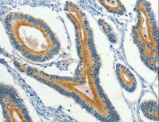 KLC1 / Kinesin Light Chain 1 Antibody - Immunohistochemistry of paraffin-embedded Human colon cancer using KLC1 Polyclonal Antibody at dilution of 1:40.