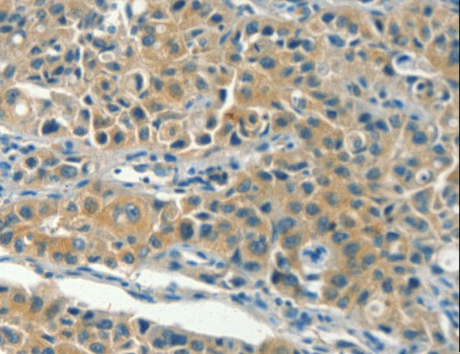 KLC1 / Kinesin Light Chain 1 Antibody - Immunohistochemistry of paraffin-embedded Human lung cancer using KLC1 Polyclonal Antibody at dilution of 1:40.