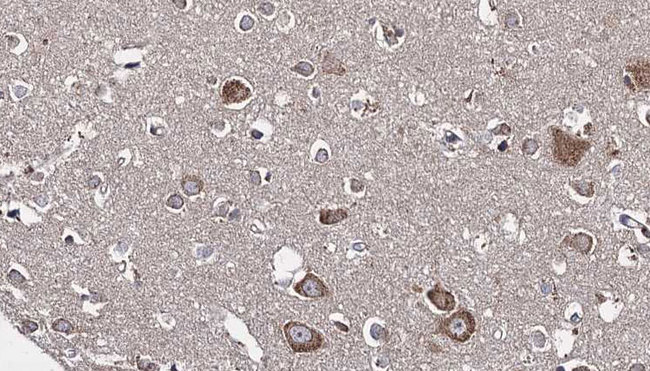 KLC1 / Kinesin Light Chain 1 Antibody - 1:100 staining human brain carcinoma tissue by IHC-P. The sample was formaldehyde fixed and a heat mediated antigen retrieval step in citrate buffer was performed. The sample was then blocked and incubated with the antibody for 1.5 hours at 22°C. An HRP conjugated goat anti-rabbit antibody was used as the secondary.