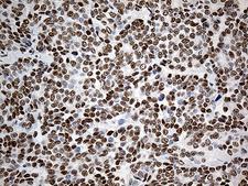 KLF11 Antibody - Immunohistochemical staining of paraffin-embedded Adenocarcinoma of Human breast tissue tissue using anti-KLF11 mouse monoclonal antibody. (Heat-induced epitope retrieval by 1mM EDTA in 10mM Tris buffer. (pH8.5) at 120°C for 3 min. (1:1000)