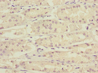 KLF15 Antibody - Immunohistochemistry of paraffin-embedded human gastric cancer at dilution 1:100