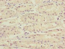 KLF15 Antibody - Immunohistochemistry of paraffin-embedded human gastric cancer at dilution 1:100