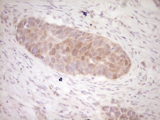 KLF2 Antibody - Immunohistochemical staining of paraffin-embedded Carcinoma of Human kidney tissue using anti-KLF2 mouse monoclonal antibody. (Heat-induced epitope retrieval by 1 mM EDTA in 10mM Tris, pH8.5, 120C for 3min,