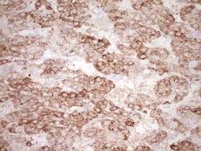 KLF2 Antibody - Immunohistochemical staining of paraffin-embedded Carcinoma of Human liver tissue using anti-KLF2 mouse monoclonal antibody. (Heat-induced epitope retrieval by 1 mM EDTA in 10mM Tris, pH8.5, 120C for 3min,